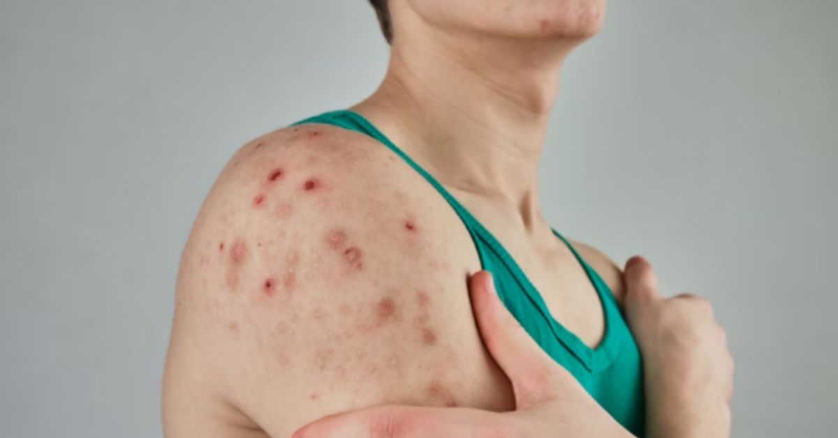 Measles Outbreaks Surge Across US and Canada Amid Declining Vaccination Rates Measles Outbreaks Surge Across US and Canada Amid Declining Vaccination Rates